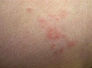 Bed bug bites on skin