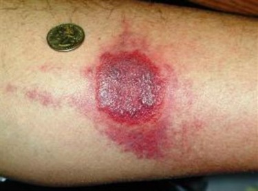 Bed bug bites – severe reaction