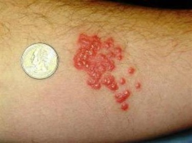 Bed bug bites – severe reaction