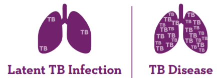 Image of two sets of lungs, one with a latent TB infection and the other with the TB disease