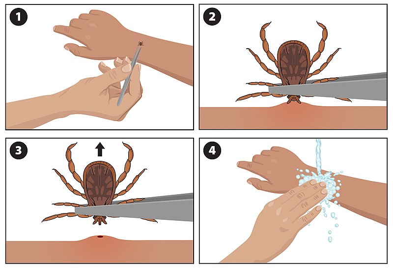 4 steps to remove a tick using tweezers and washing hands when done